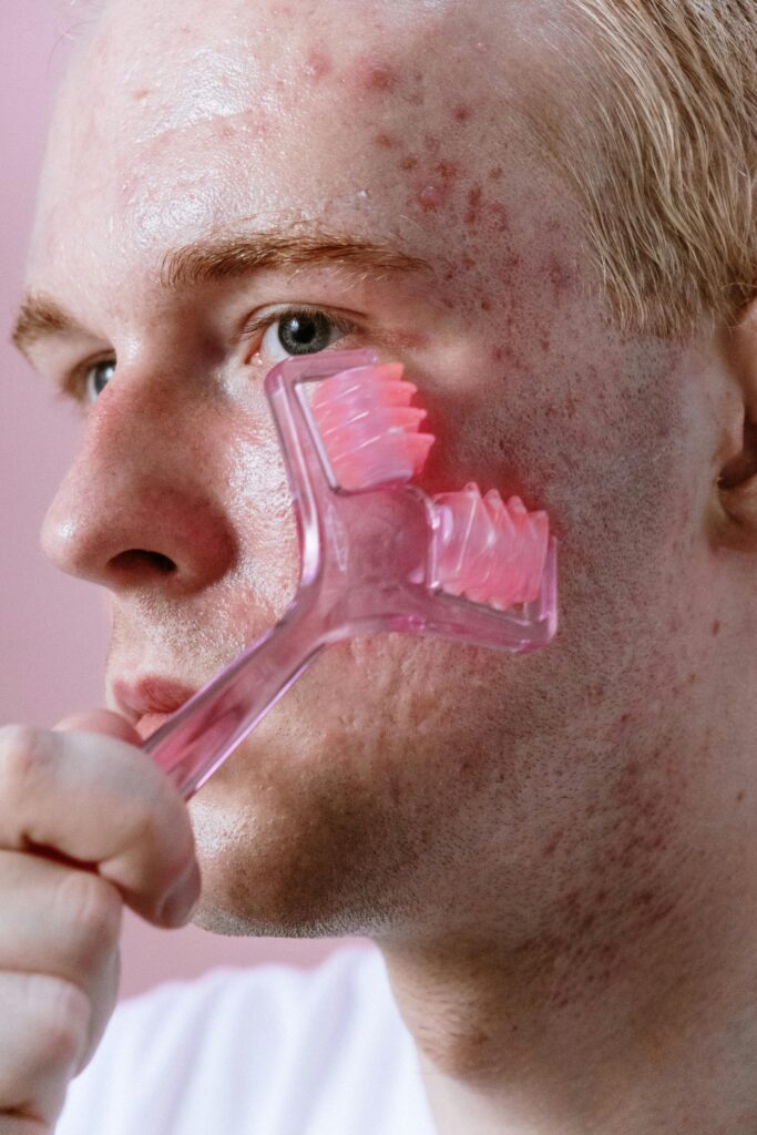 Why Do Men Get More Acne Than Women? Man using a derma roller on acne-prone skin
